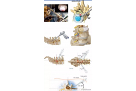 脊柱微创手术的常用技术——通道技术及内镜技术